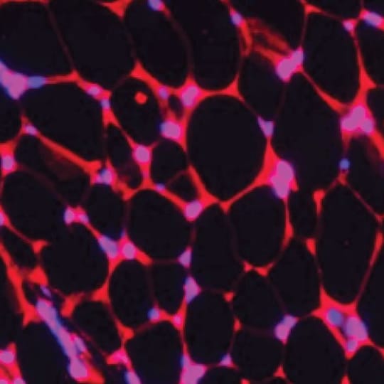 Bioengineered Fat Cells Show Promise in Cancer Treatment